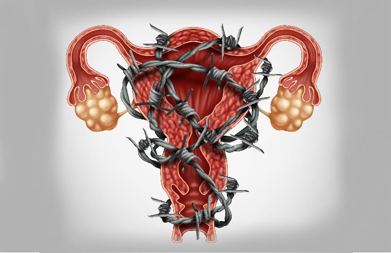¿Qué es la endometriosis?