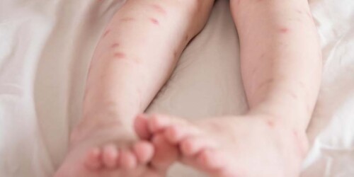 Bebés con Zika podrían sufrir discapacidades cognitivas al crecer