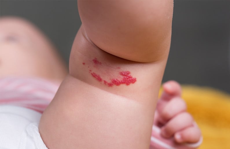 todo-sobre-las-nevus-en-fresa-o-hemangiomas-manchas-de-nacimiento