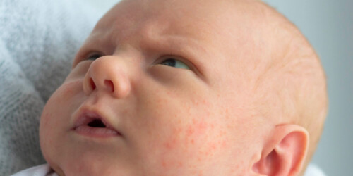 ¿Qué es la miliaria en recién nacidos?