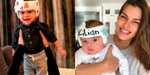 Cascos correctores para bebés: todo lo que debes saber