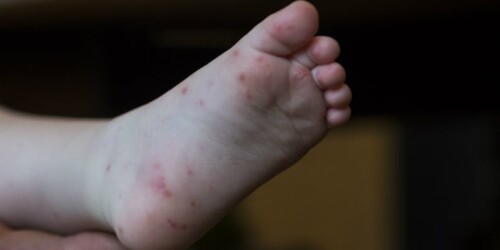 ¡Alerta! El virus coxsackie se detectó en siete estados de México 