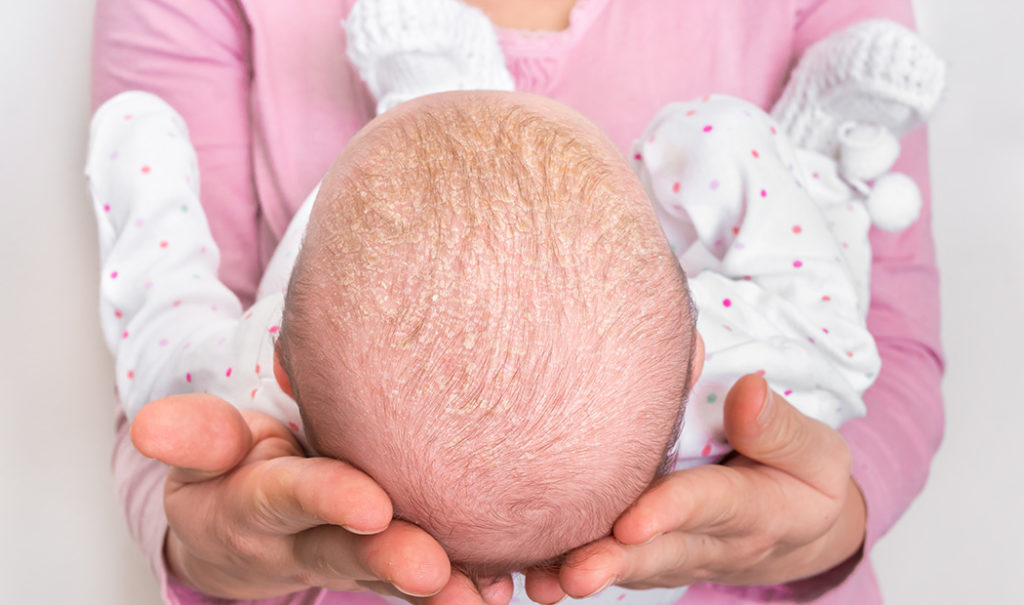 Alopecia infantil: tipos y causas