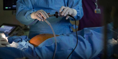 Cirugía exitosa de fotocoagulación láser fetal en gemelos en México