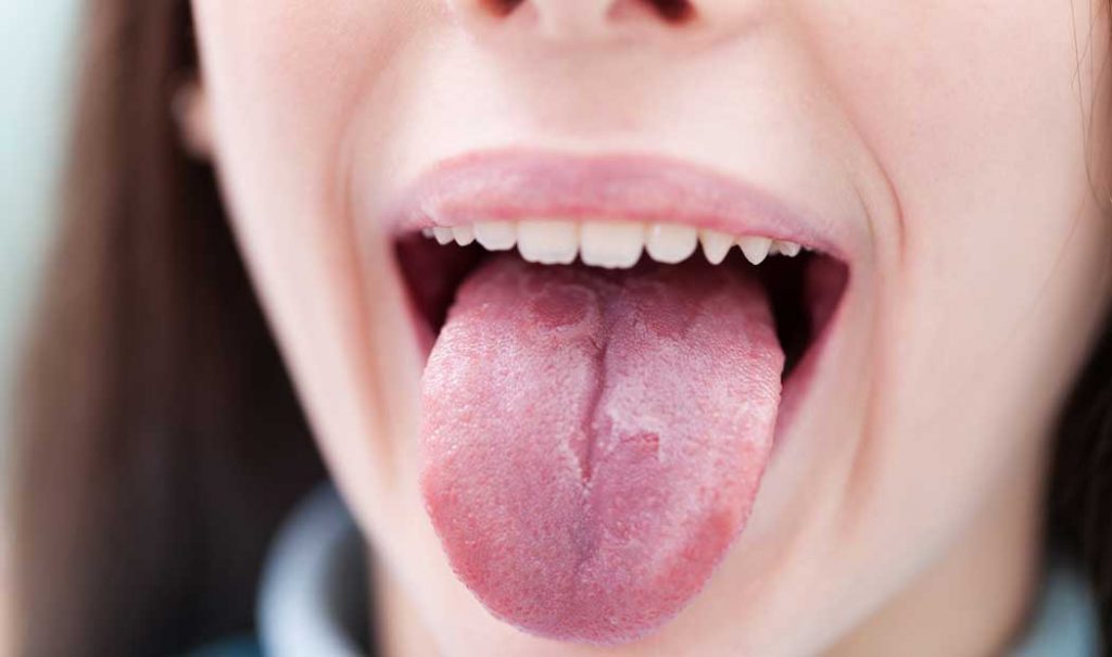 ¿Tu hijo tiene lengua geográfica?