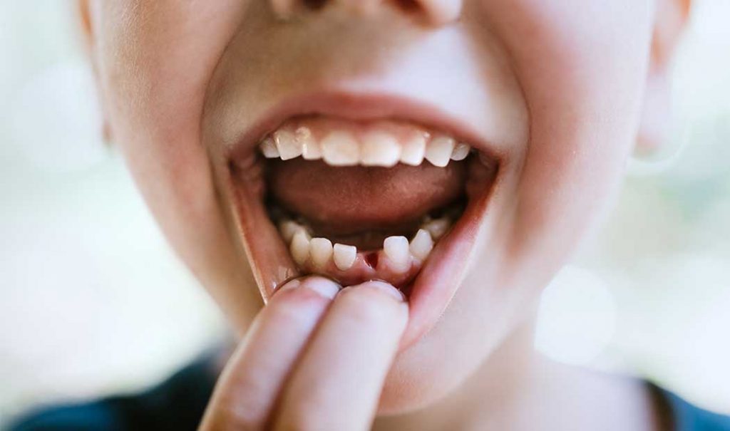 ¿Cómo cuidar la caída de los dientes de leche y evitar que tus hijos usen brackets?