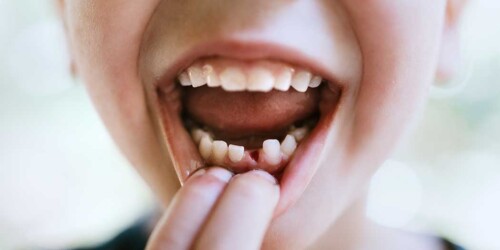 ¿Cómo cuidar la caída de los dientes de leche y evitar que tus hijos usen brackets?
