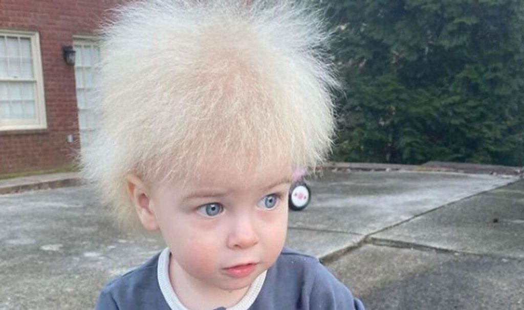 El raro Síndrome de Cabello Imposible de Peinar y el caso del niño que dio vuelta al mundo