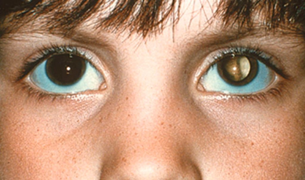 Cáncer ocular en niños: ¿Cómo saber si mi hijo tiene retinoblastoma?