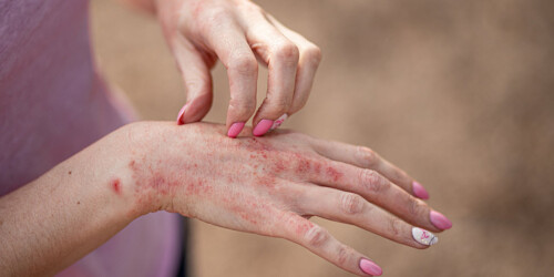 ¿Piel sensible en el embarazo? Puede ser psoriasis