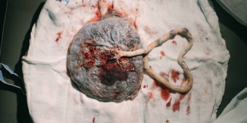 Células madre de cordón umbilical, posible cura contra VIH