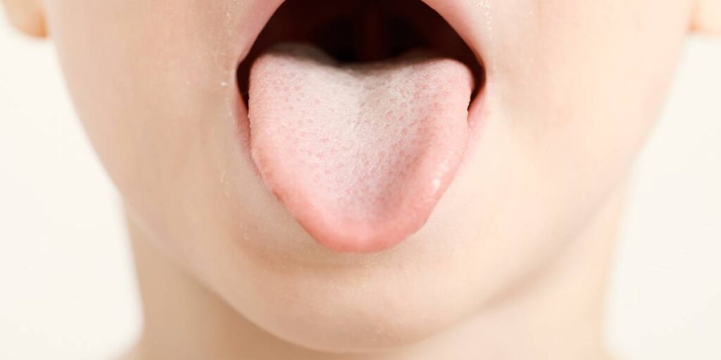 Cómo saber si un niño  tiene escarlatina