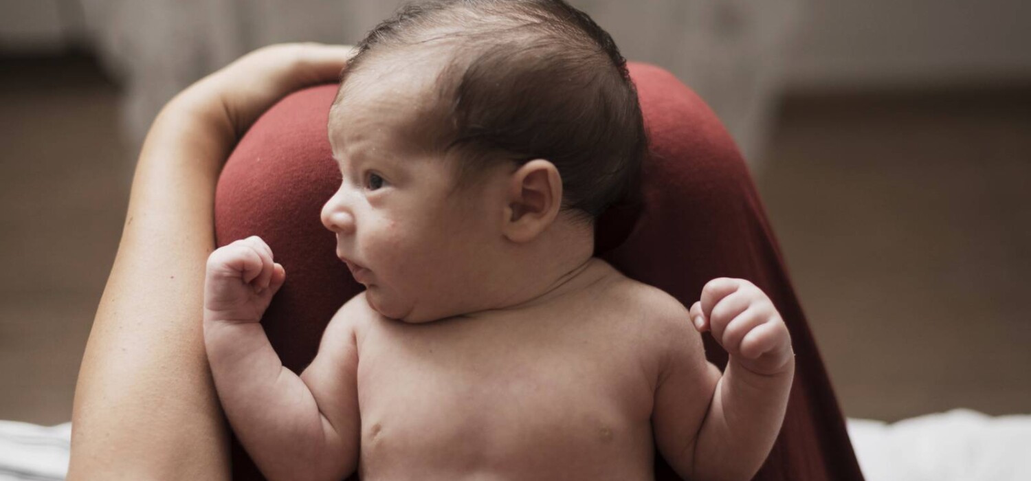 sindrome del hombre lobo en bebes