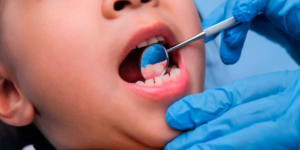 Torus mandibular ¿es un tumor?