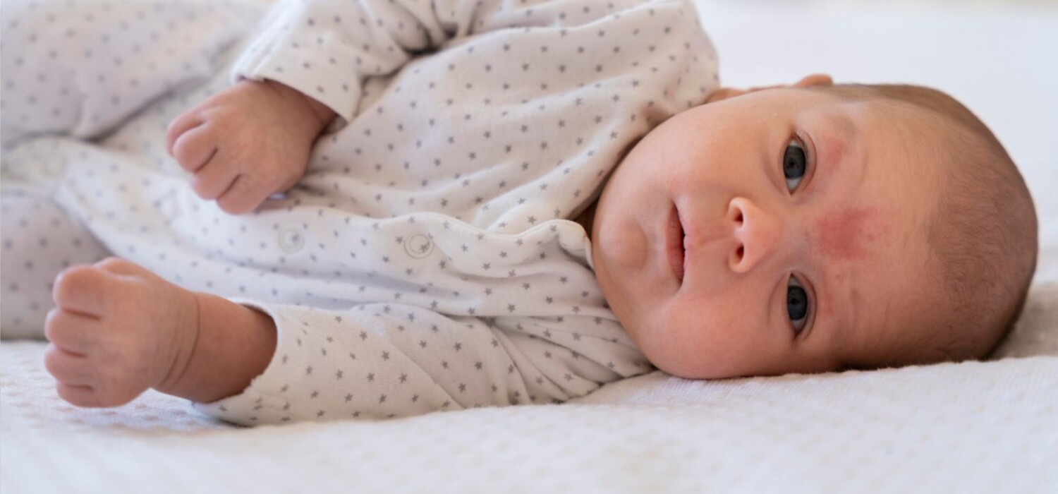 acne en bebes