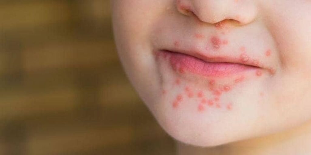 Síntomas del virus Coxsackie: enfermedad manos-pies-boca