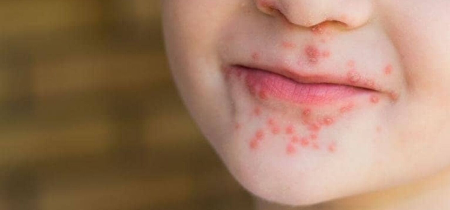 Síntomas del virus Coxsackie