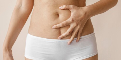 Tipos de cicatriz en cesárea: ¿Horizontal o vertical?