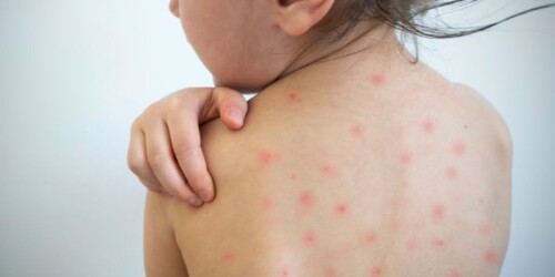 Así van subiendo los casos de sarampión en México