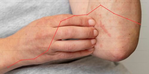 Brote de sarampión en México 2025: niños de 0-4 años son los más afectados